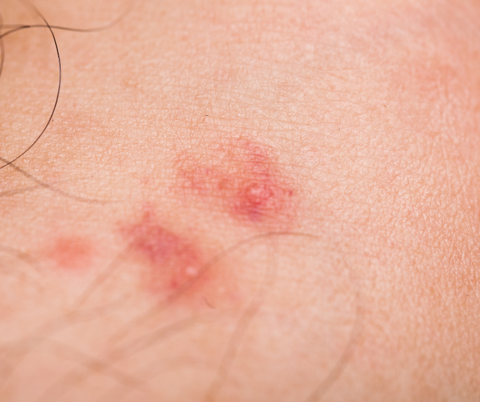 איך מזהים עקיצות של פשפשים?